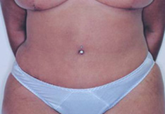 After Tummy Tuck