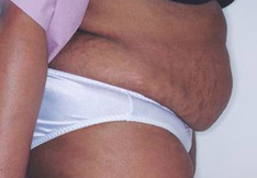 Before Tummy Tuck