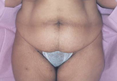 Before Tummy Tuck