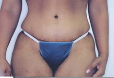 After Tummy Tuck