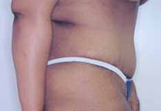 After Tummy Tuck