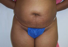 Before Tummy Tuck