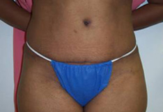 After Tummy Tuck