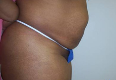 Before Tummy Tuck