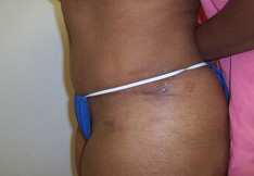 After Tummy Tuck
