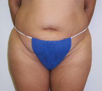 Before Tummy Tuck