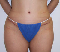 After Tummy Tuck