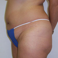 Before Tummy Tuck