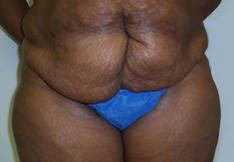 Before Tummy Tuck