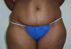 After Tummy Tuck