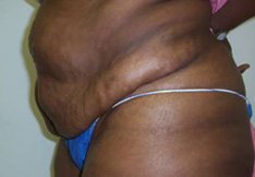 Before Tummy Tuck