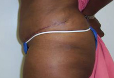 After Tummy Tuck