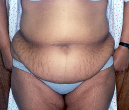 Before Tummy Tuck