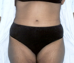 After Tummy Tuck