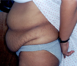 Before Tummy Tuck
