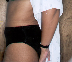 After Tummy Tuck