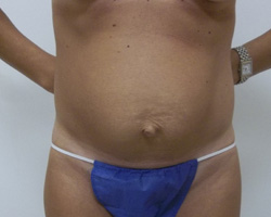 Before Tummy Tuck