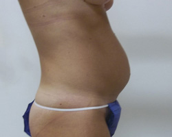 Before Tummy Tuck