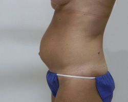 Before Tummy Tuck