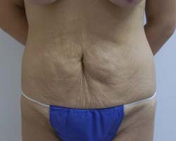 Before Tummy Tuck