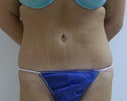 After Tummy Tuck