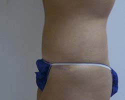 After Tummy Tuck