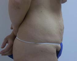 Before Tummy Tuck