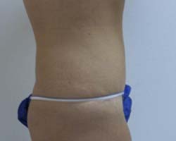 After Tummy Tuck
