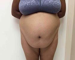 Before Tummy Tuck