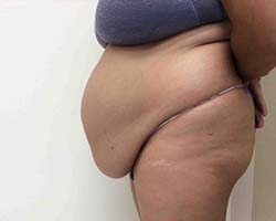 Before Tummy Tuck
