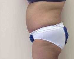 After Tummy Tuck