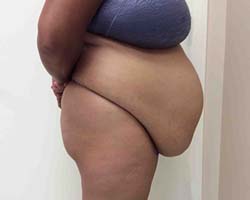 Before Tummy Tuck