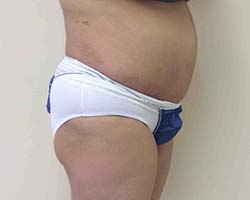After Tummy Tuck