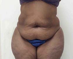Before Tummy Tuck