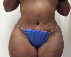 After Tummy Tuck