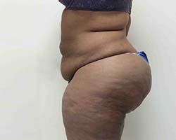 Before Tummy Tuck