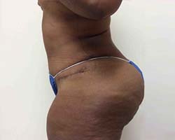 After Tummy Tuck