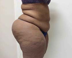 Before Tummy Tuck