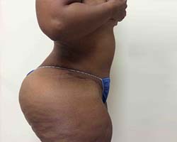After Tummy Tuck