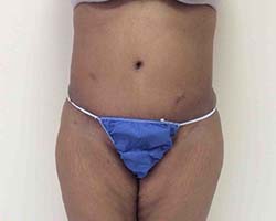 After Tummy Tuck