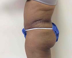 After Tummy Tuck