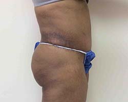 After Tummy Tuck
