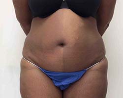Before Tummy Tuck