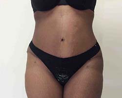 After Tummy Tuck