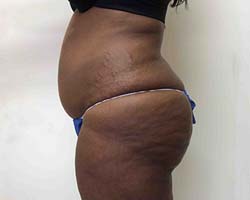 Before Tummy Tuck
