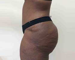 After Tummy Tuck