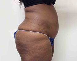 Before Tummy Tuck
