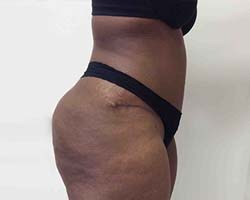 After Tummy Tuck