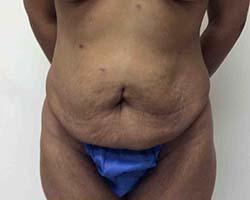 Before Tummy Tuck