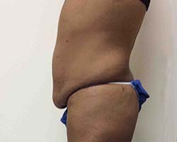Before Tummy Tuck